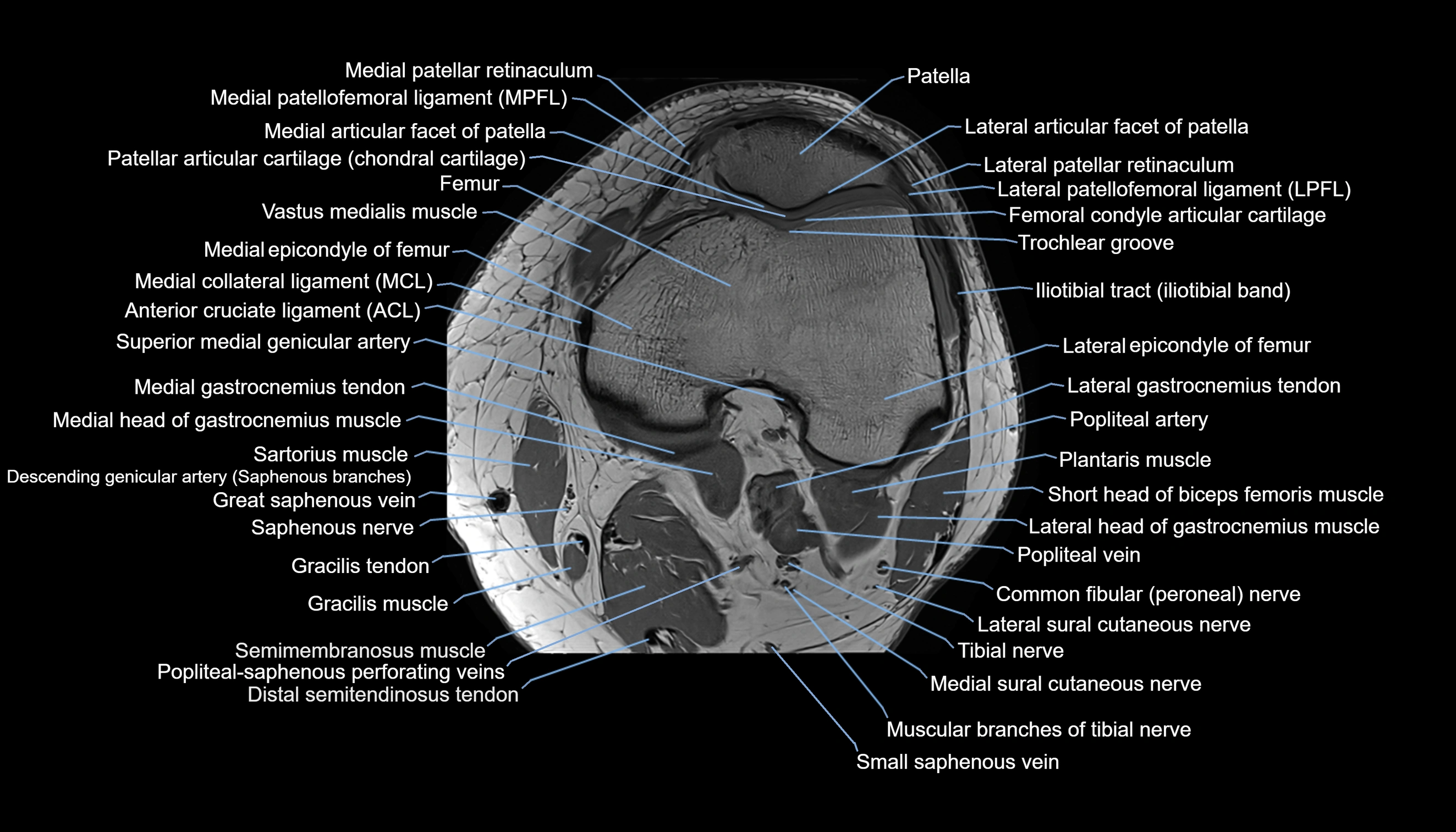 MRI knee  axial cross sectional anatomy 3T radiology  image-img-00001-00017.webp